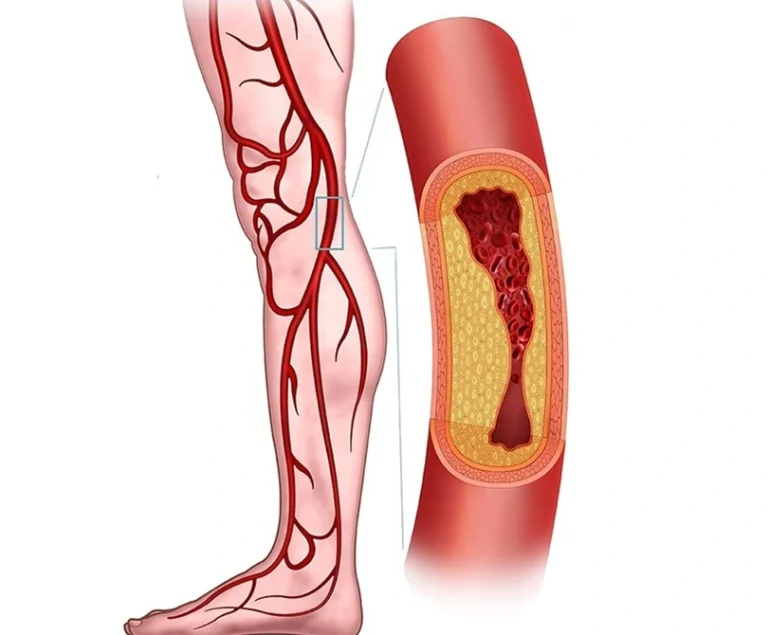 vascular surgery