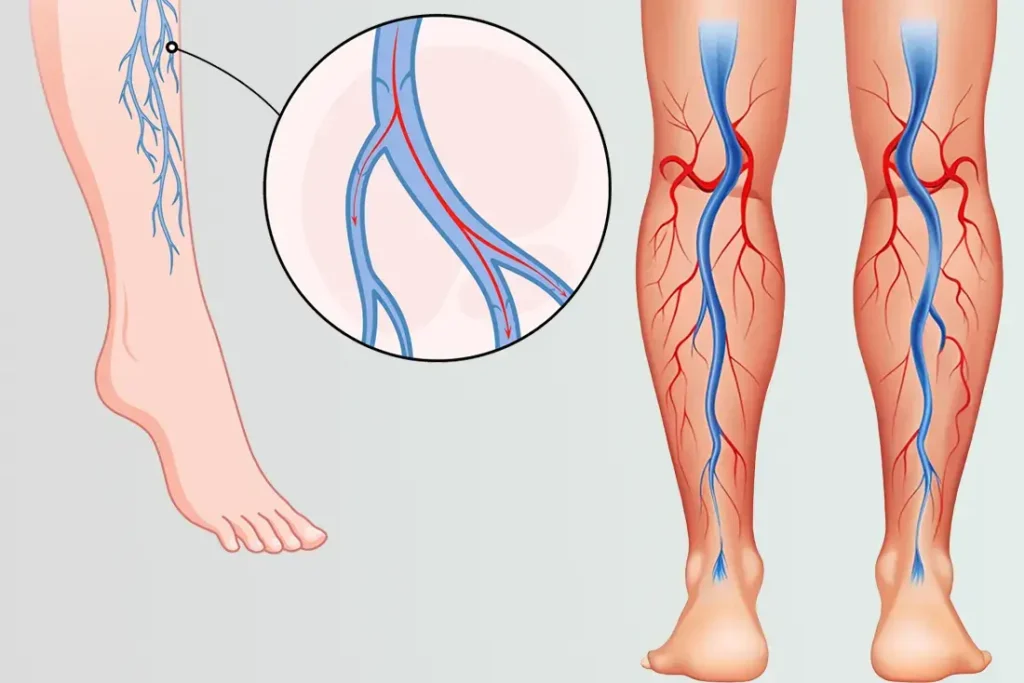 Varicose Vein