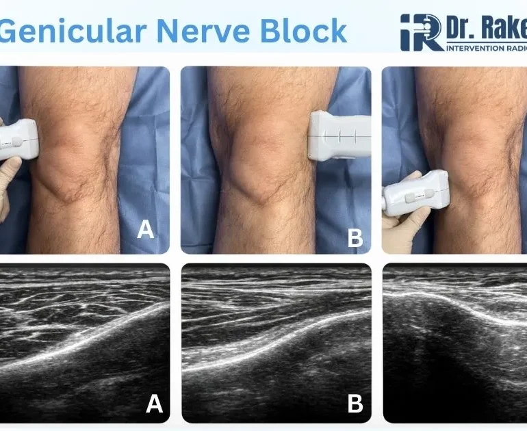 Genicular Nerve Block Treatment