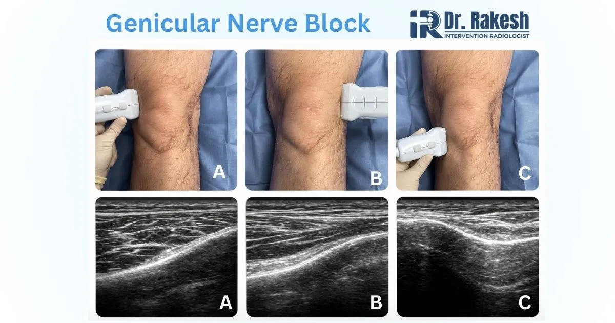 Genicular Nerve Block Treatment