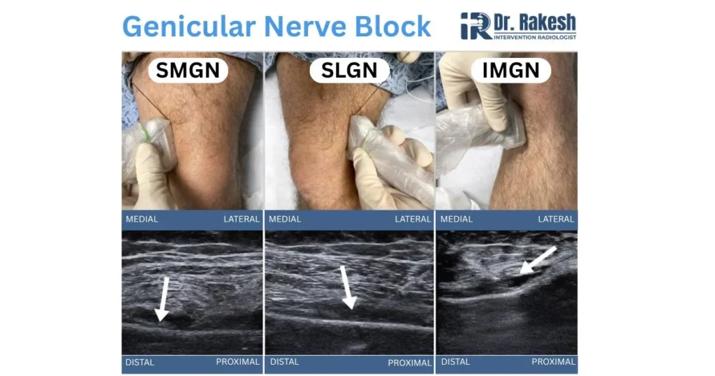 Genicular Nerve Block Treatment