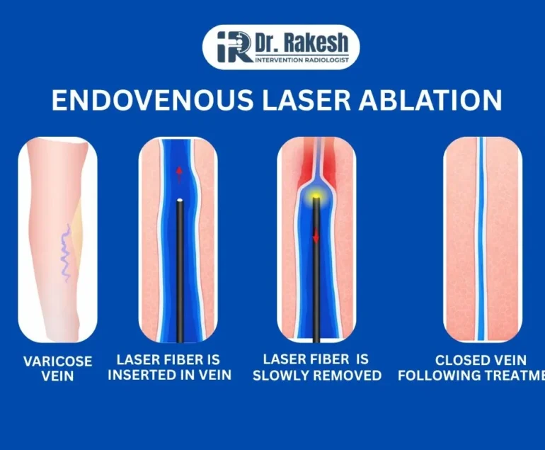 ENDOVENOUS LASER ABLATION