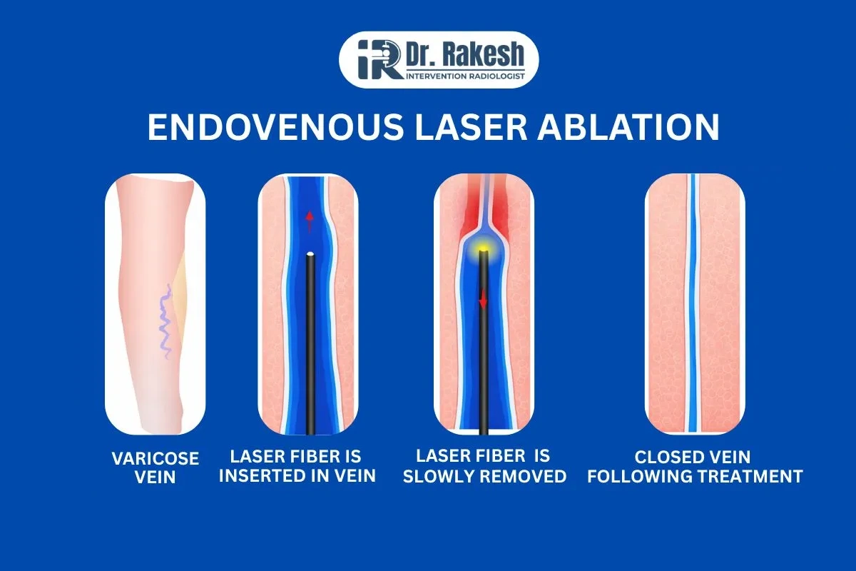 ENDOVENOUS LASER ABLATION
