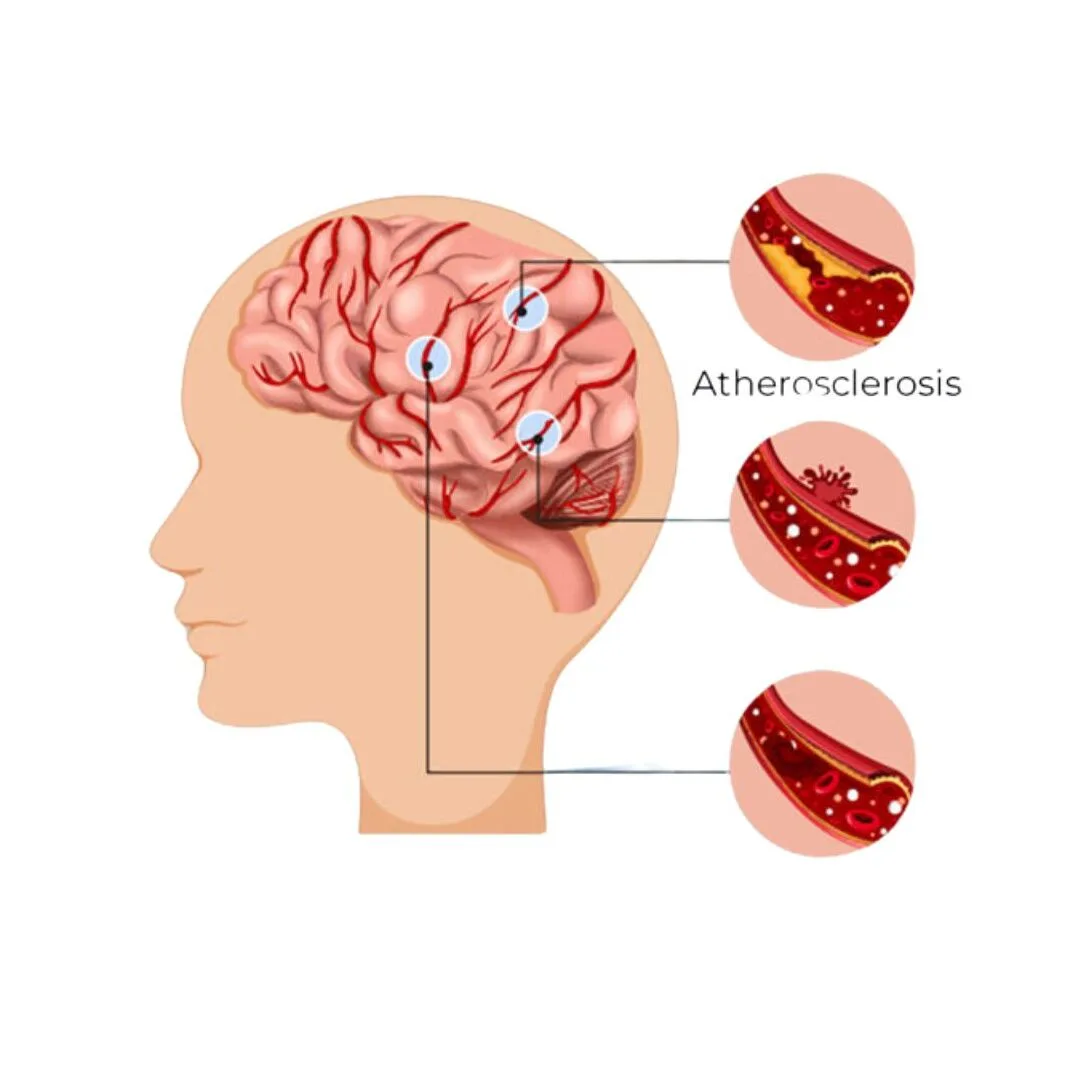 Neuro interventions-Mechanical-Thrombectomy