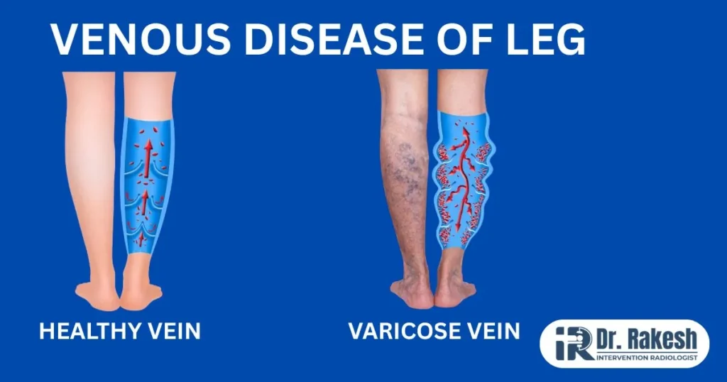 Varicose Veins