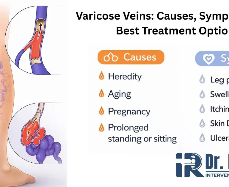 Varicose Veins