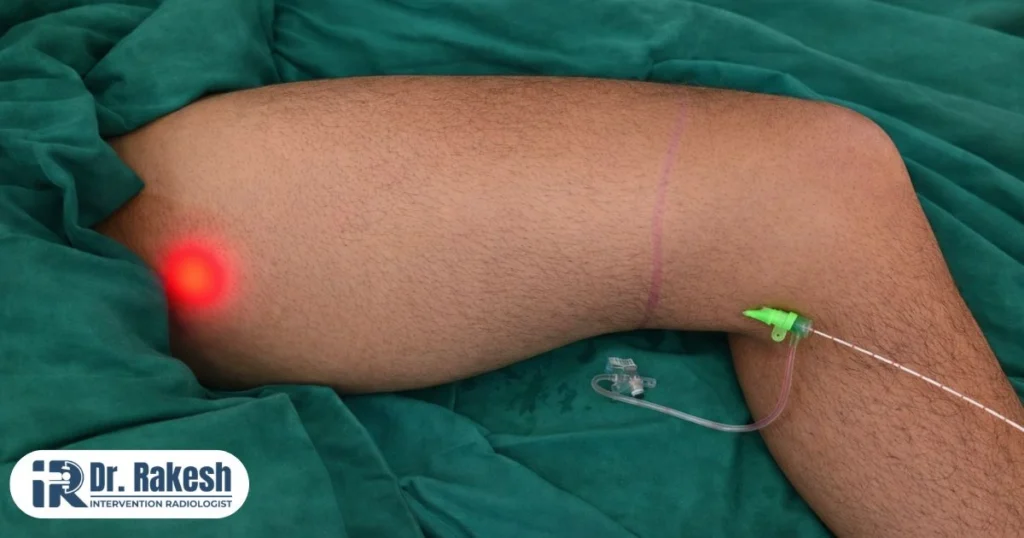 dr rakesh website Why Laser Treatment is the Best Solution