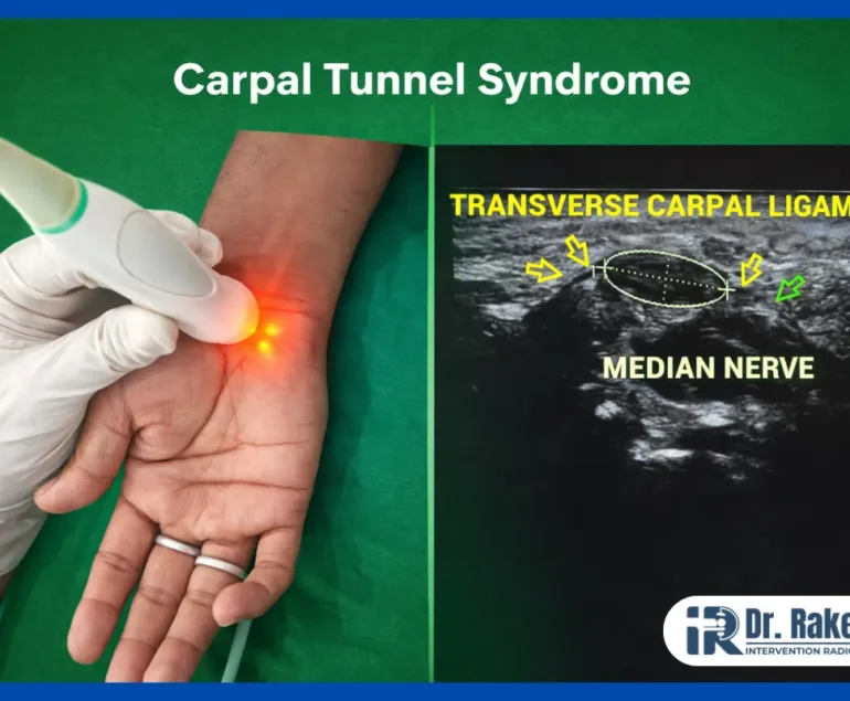 Carpal Tunnel Syndrome Causes Sy_mptoms