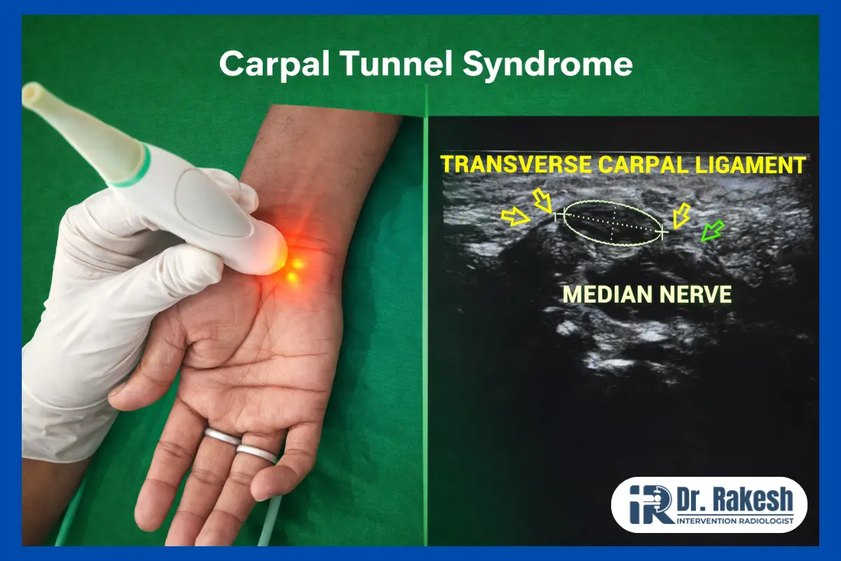 Carpal Tunnel Syndrome Causes Sy_mptoms
