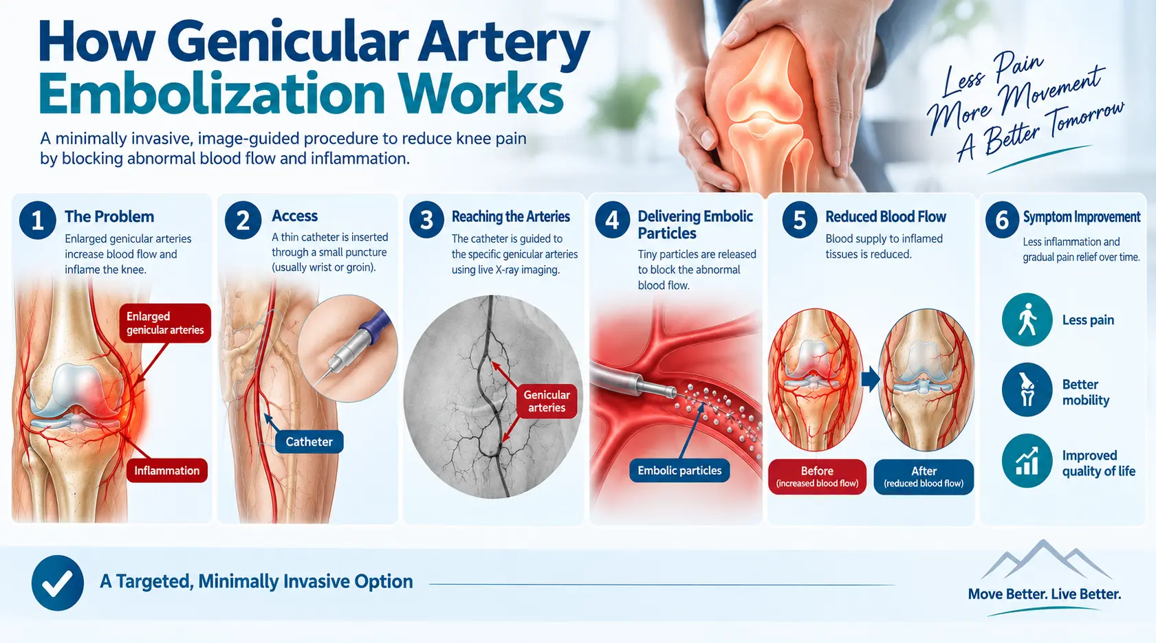 How Genicular Artery Embolization Works