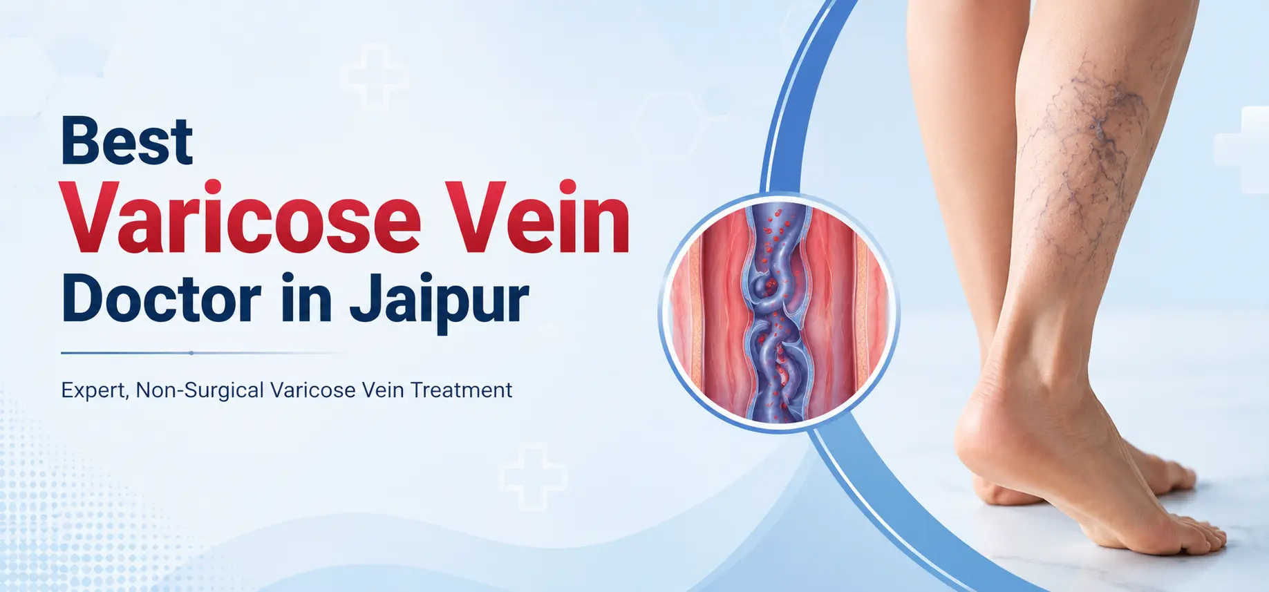 Varicose vein doctor in Jaipur