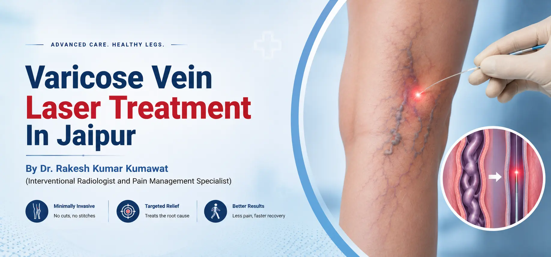 Varicose Vein Laser Treatment In Jaipur